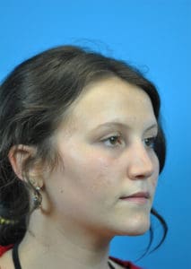 Rhinoplasty Before and After Pictures Indianapolis, IN