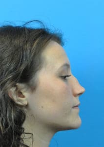 Rhinoplasty Before and After Pictures Indianapolis, IN
