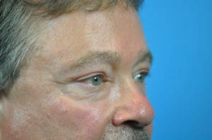 Blepharoplasty Before and After Pictures Indianapolis, IN