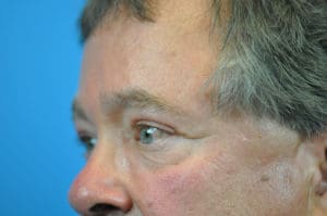 Blepharoplasty Before and After Pictures Indianapolis, IN