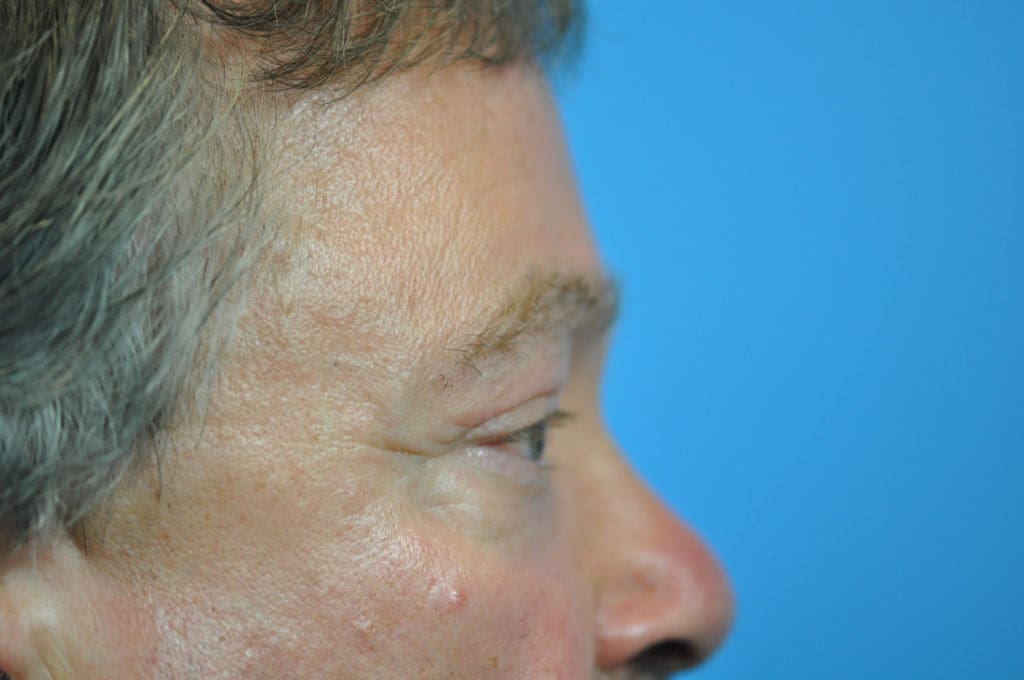 Blepharoplasty Before and After Pictures Indianapolis, IN