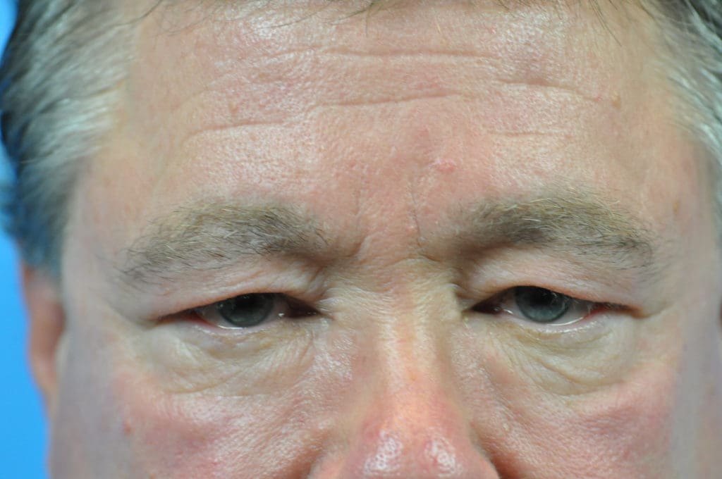 Blepharoplasty Before and After Pictures Indianapolis, IN