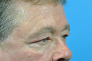 Blepharoplasty Before and After Pictures Indianapolis, IN