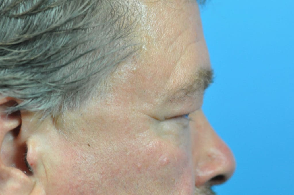 Blepharoplasty Before and After Pictures Indianapolis, IN