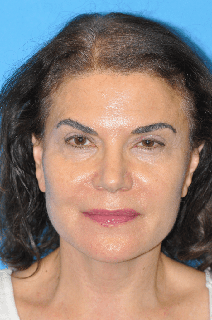 Facelift Before & After Pictures In Indianapolis, Indiana