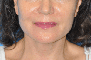 Facelift Before & After Pictures In Indianapolis, Indiana