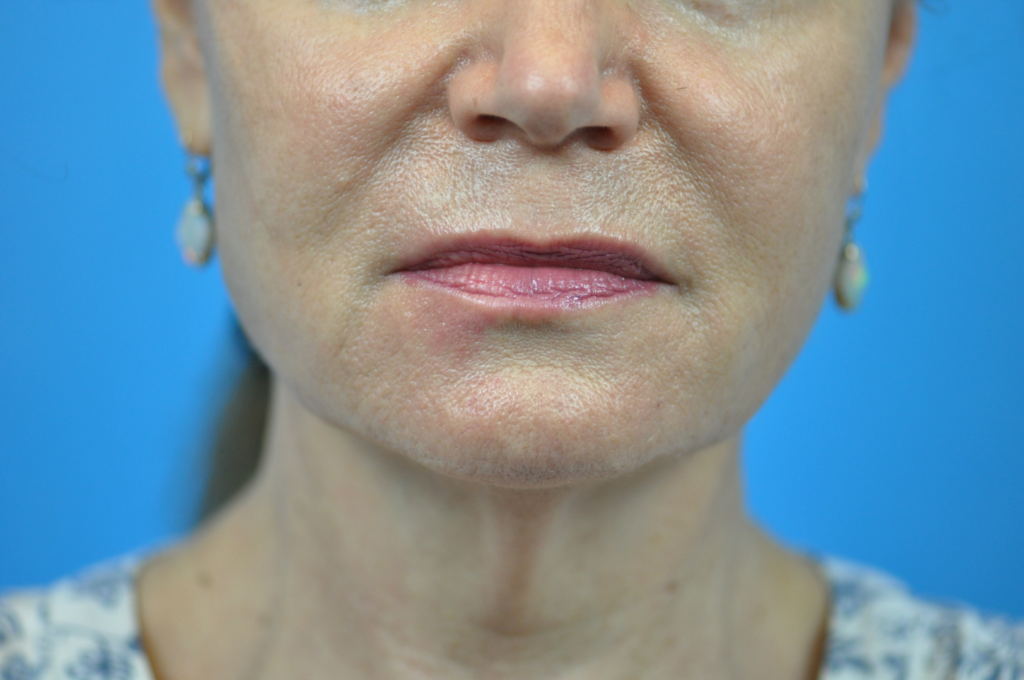 Facelift Before & After Pictures In Indianapolis, Indiana