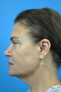 Facelift Before & After Pictures In Indianapolis, Indiana