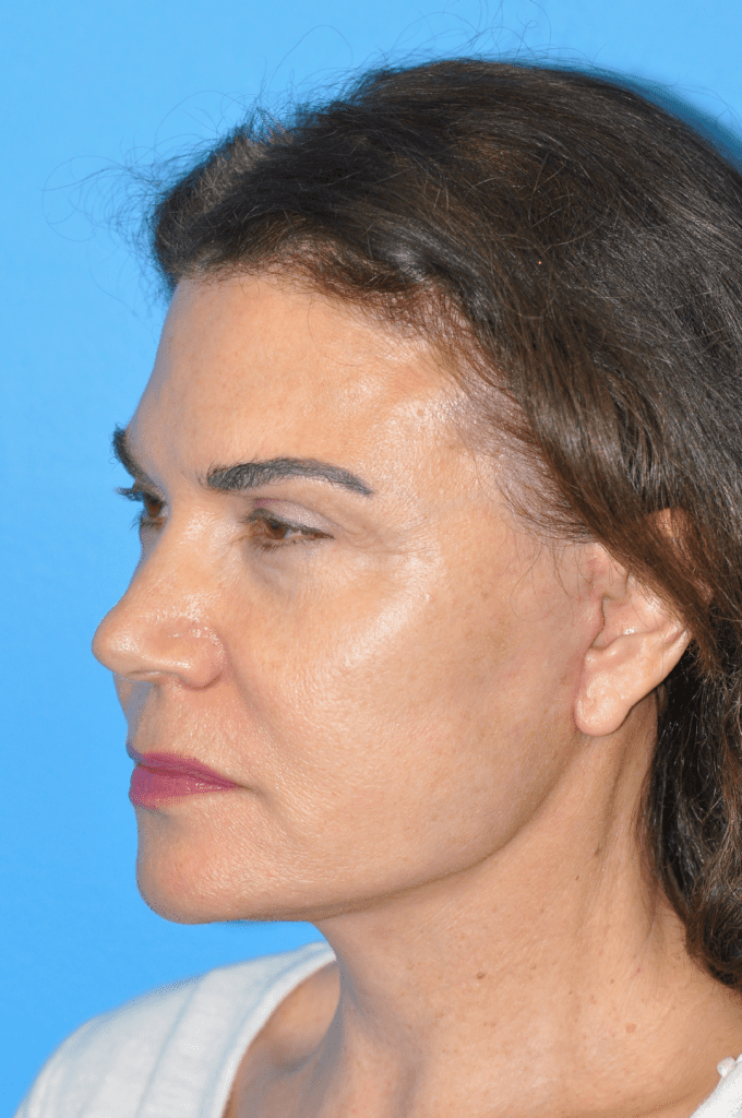 Facelift Before & After Pictures In Indianapolis, Indiana