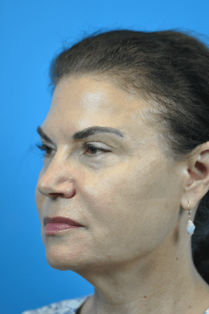 Facelift Before & After Pictures In Indianapolis, Indiana