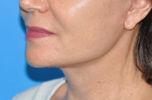 Facelift Before & After Pictures In Indianapolis, Indiana