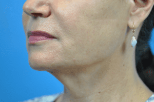 Facelift Before & After Pictures In Indianapolis, Indiana