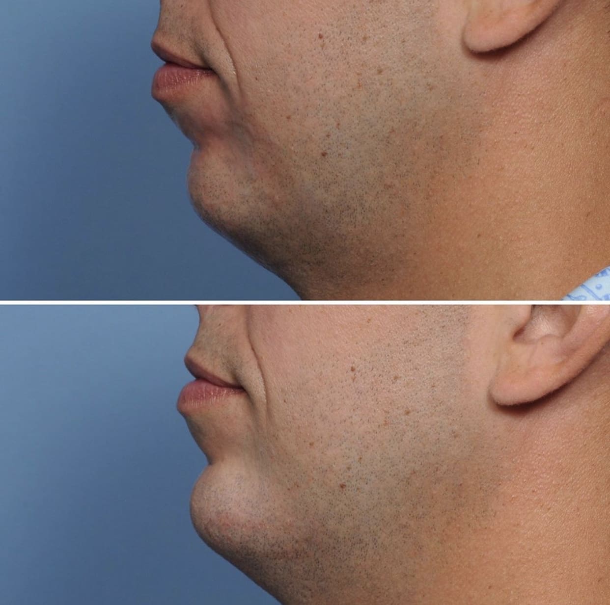 Chin Implant Before and After Pictures Indianapolis, IN