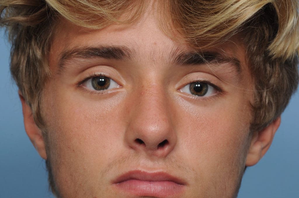 Rhinoplasty Before and After Pictures Indianapolis, IN