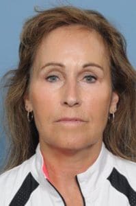 Blepharoplasty Before and After Pictures Indianapolis, IN