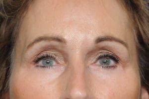 Blepharoplasty Before and After Pictures Indianapolis, IN