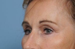 Blepharoplasty Before and After Pictures Indianapolis, IN