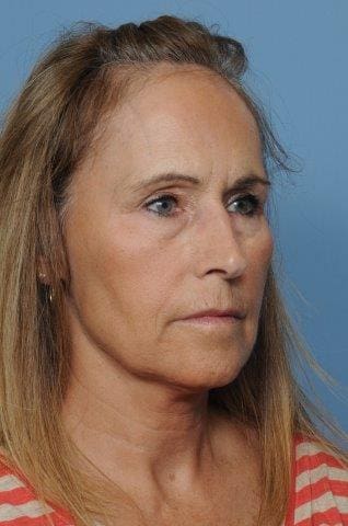 Blepharoplasty Before and After Pictures Indianapolis, IN