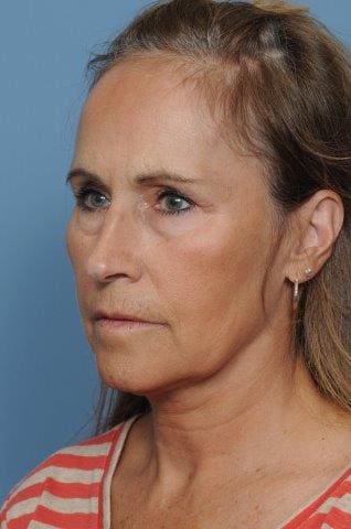 Blepharoplasty Before and After Pictures Indianapolis, IN
