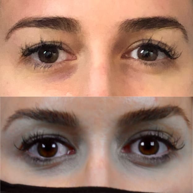 Non-Surgical Facelift in Indianapolis, Indiana