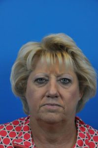 Facelift Before and After Pictures Indianapolis, IN