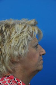 Facelift Before and After Pictures Indianapolis, IN