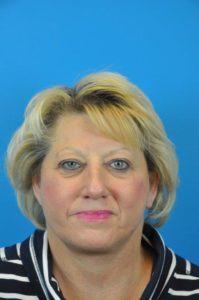 Facelift Before and After Pictures Indianapolis, IN