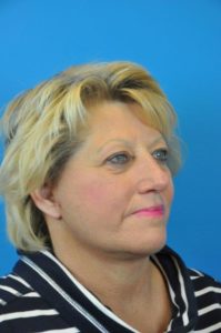 Facelift Before and After Pictures Indianapolis, IN