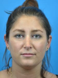 Rhinoplasty Before and After Pictures Indianapolis, IN