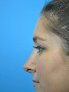 Rhinoplasty Before and After Pictures Indianapolis, IN