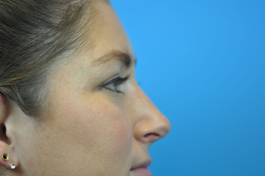 Rhinoplasty Before and After Pictures Indianapolis, IN