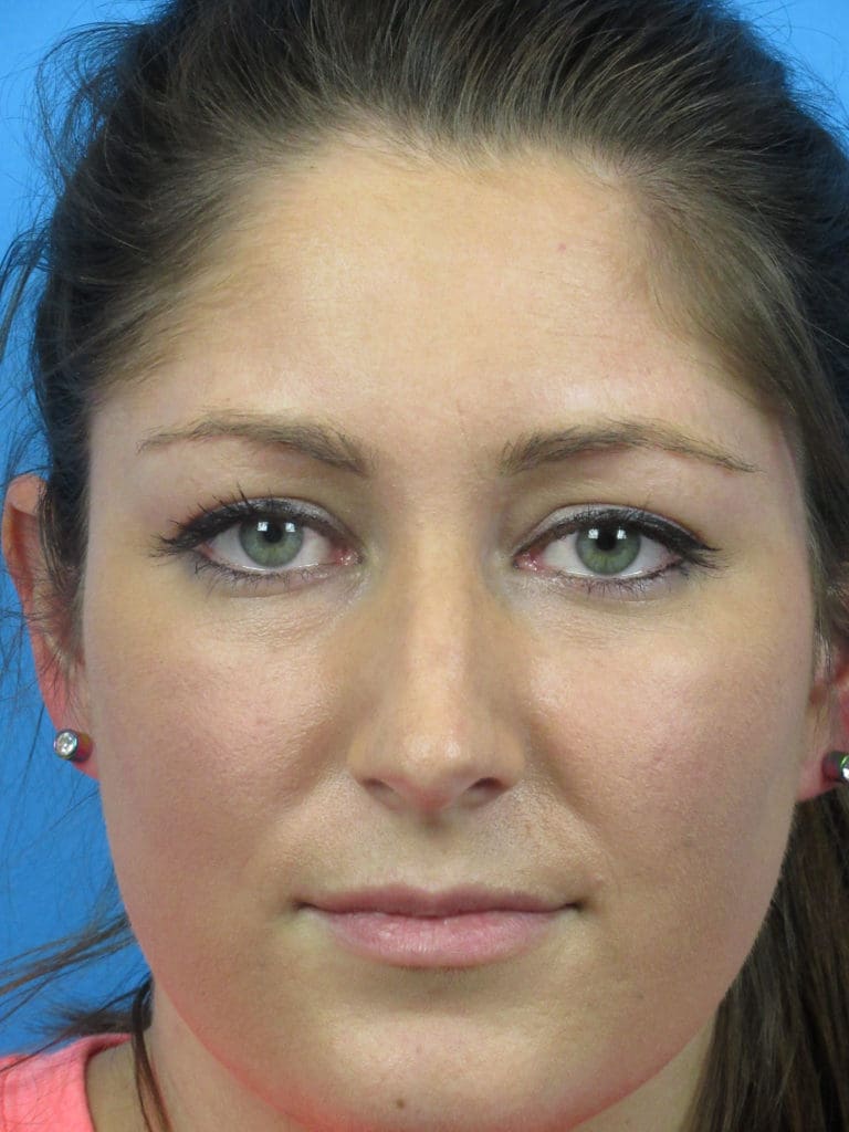 Rhinoplasty Before and After Pictures Indianapolis, IN