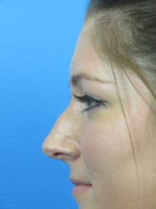Rhinoplasty Before and After Pictures Indianapolis, IN
