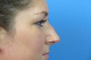 Rhinoplasty Before and After Pictures Indianapolis, IN