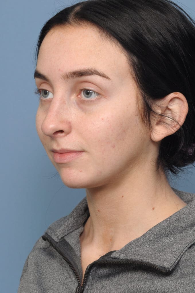 Rhinoplasty Before and After Pictures Indianapolis, IN