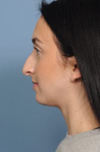 Rhinoplasty Before and After Pictures Indianapolis, IN