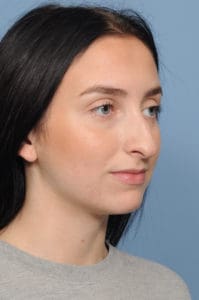 Rhinoplasty Before and After Pictures Indianapolis, IN