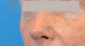 Rhinoplasty Before and After Pictures Indianapolis, IN