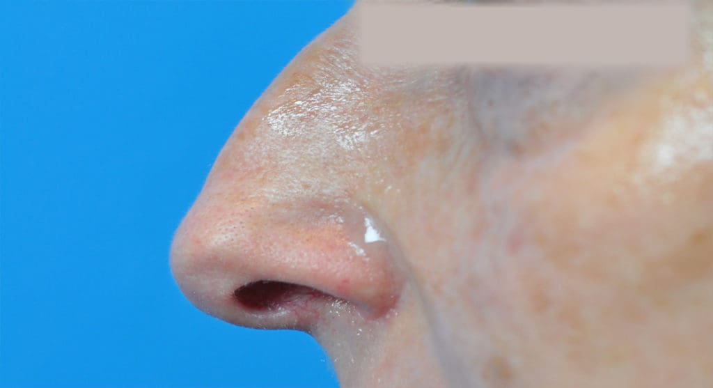 Rhinoplasty Before and After Pictures Indianapolis, IN
