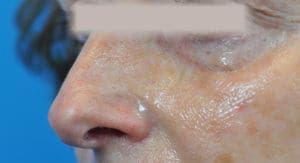 Rhinoplasty Before and After Pictures Indianapolis, IN