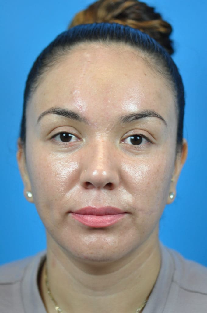 Scar Revision Before and After Pictures Indianapolis, IN
