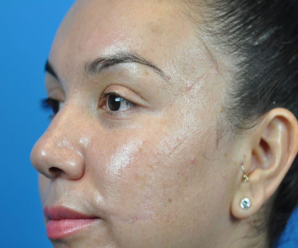 Scar Revision Before and After Pictures Indianapolis, IN