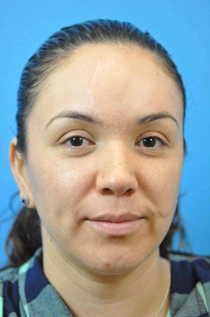 Scar Revision Before and After Pictures Indianapolis, IN
