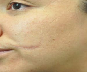Scar Revision Before and After Pictures Indianapolis, IN