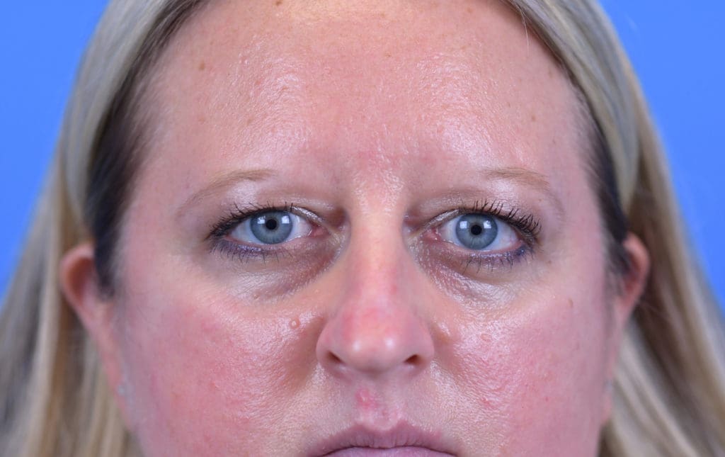 Rhinoplasty Before and After Pictures Indianapolis, IN