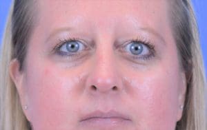 Rhinoplasty Before and After Pictures Indianapolis, IN