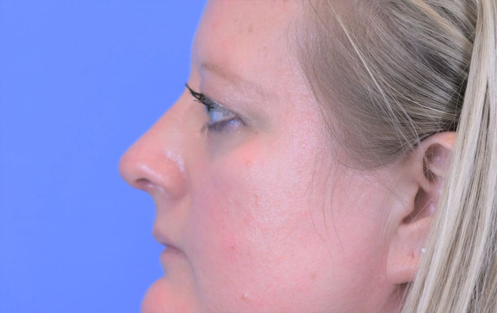 Rhinoplasty Before and After Pictures Indianapolis, IN