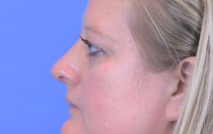 Rhinoplasty Before and After Pictures Indianapolis, IN