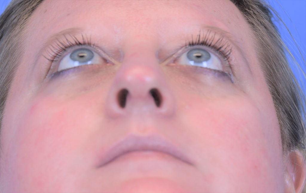 Rhinoplasty Before and After Pictures Indianapolis, IN