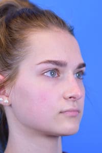 Rhinoplasty Before and After Pictures Indianapolis, IN